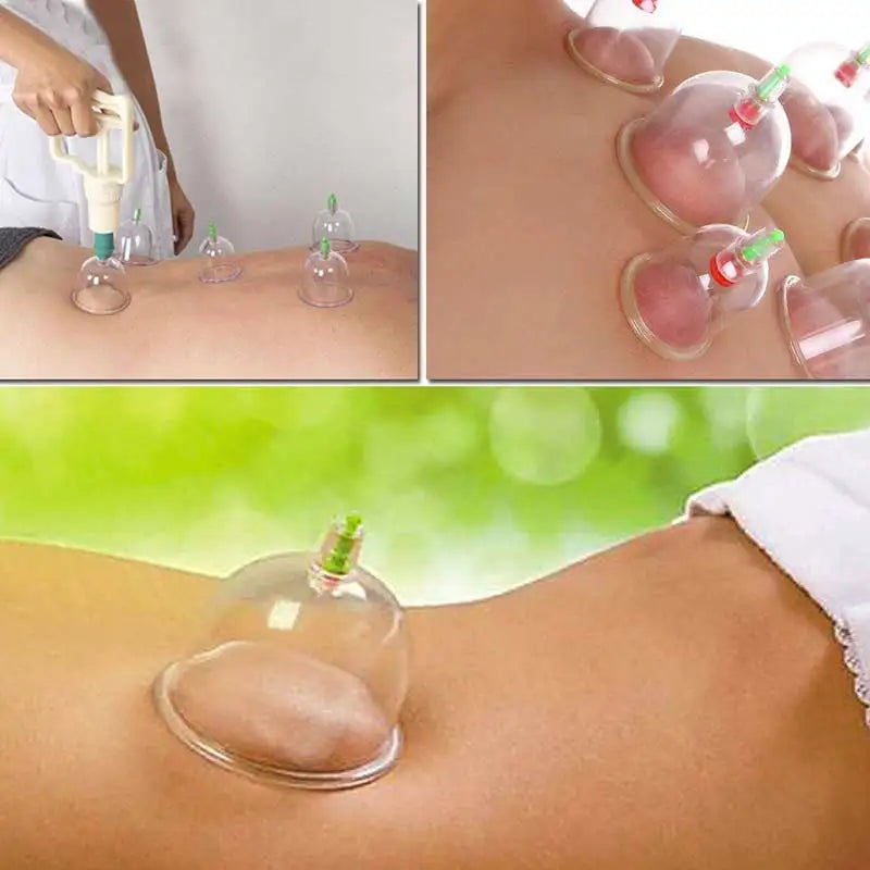 6pcs Medical Vacuum Cupping,Chinese Massage Cupping Therapy Kits with Suction Pump,Vacuum Suction Cups for Muscle Soreness